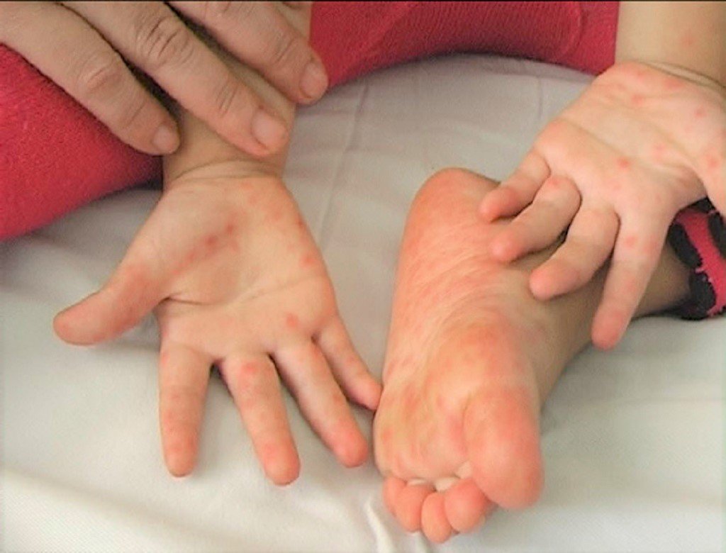 Hướng dẫn phương pháp phòng bệnh tay chân miệng cho trẻ hiệu quả nhất