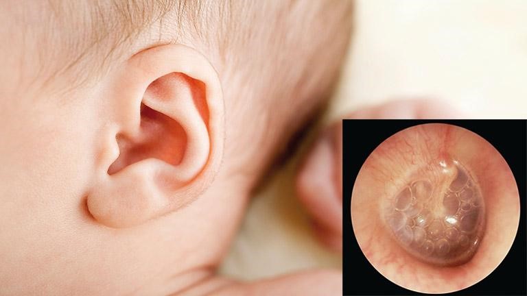 Viêm tai giữa có tràn dịch (OME) thường làm cho trẻ bị sốt và đau đầu